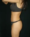 Brazilian Butt Lift case #3570
