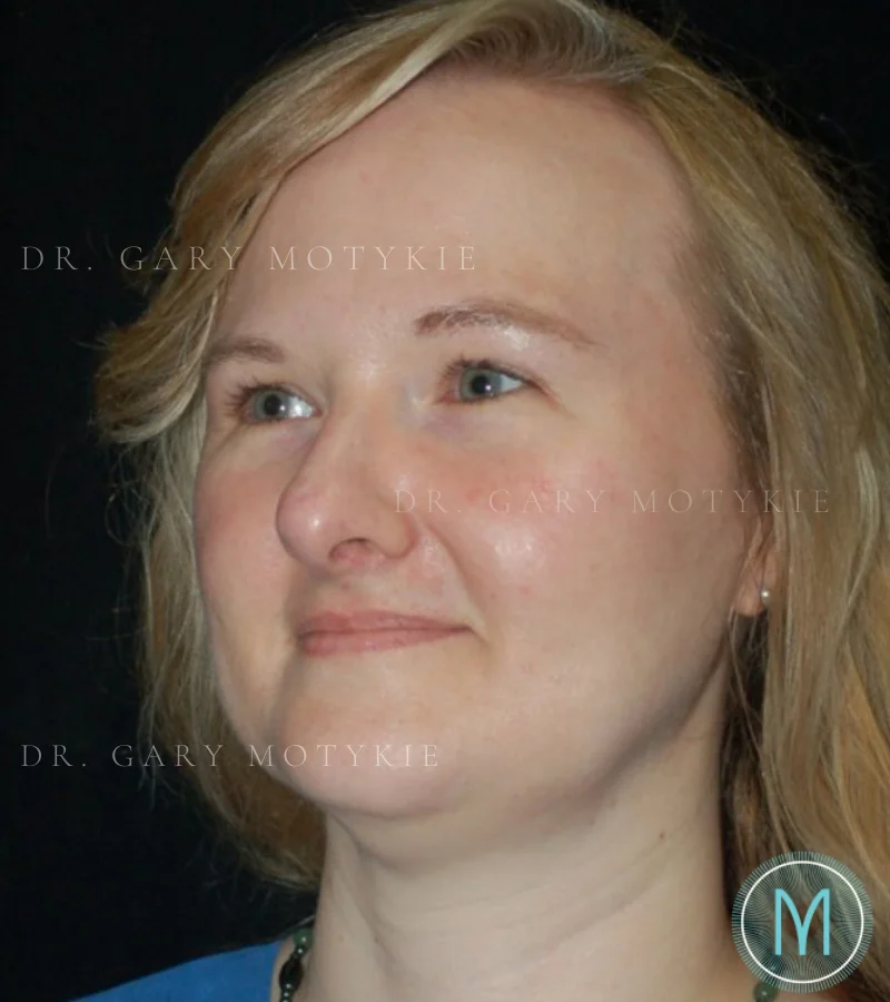 Brow Lift case #4071