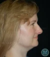Brow Lift case #4071