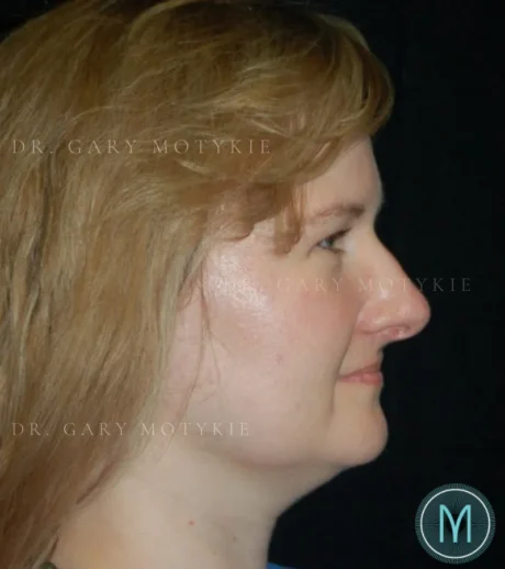 Brow Lift case #4071