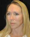 Lower Blepharoplasty case #3385
