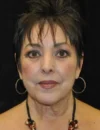 Blepharoplasty case #3493