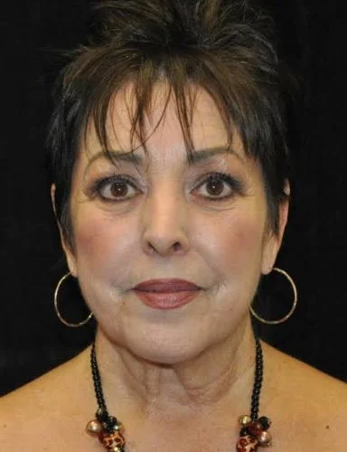 Blepharoplasty case #3493