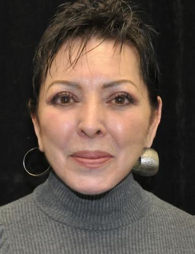 Blepharoplasty case #3493