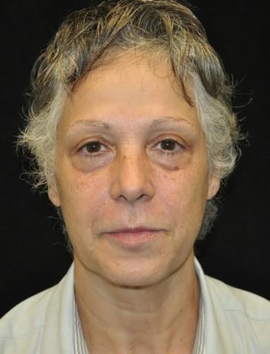 Lower Blepharoplasty case #3390