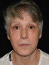 Lower Blepharoplasty case #3390