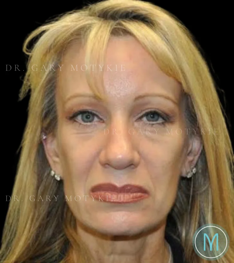 case-3-25-brow-lift-view-1-1