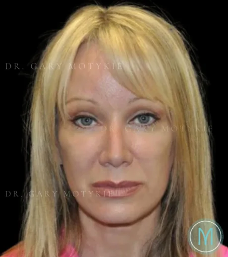 Brow Lift case #4076