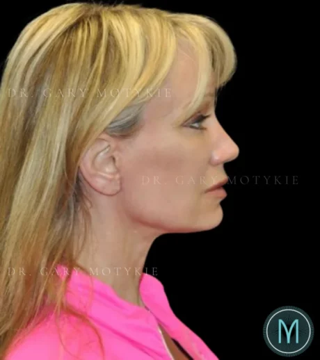 Brow Lift case #4076