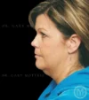 Neck Lift case #4865