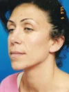 Blepharoplasty case #3487