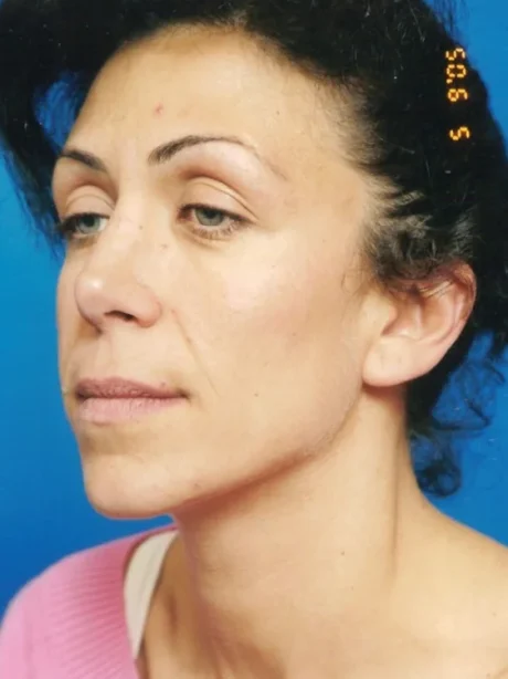 Blepharoplasty case #3487