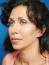 Blepharoplasty case #3487
