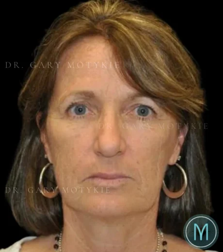 Brow Lift case #4083