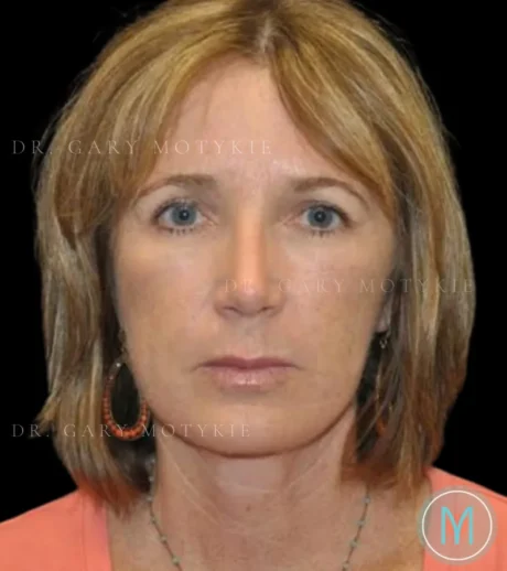 Brow Lift case #4083
