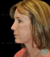 Brow Lift case #4083