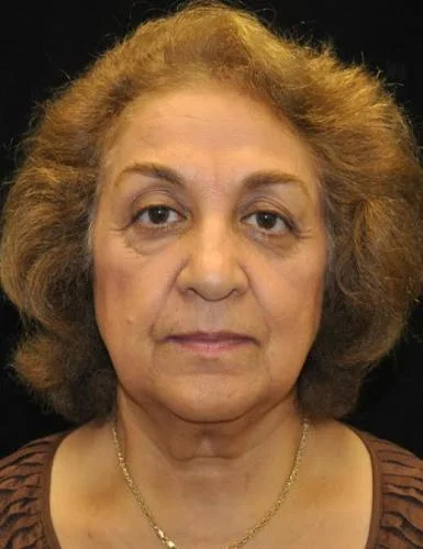 Lower Blepharoplasty case #3395