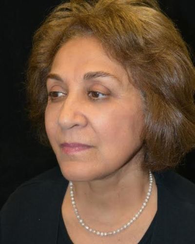 Lower Blepharoplasty case #3395