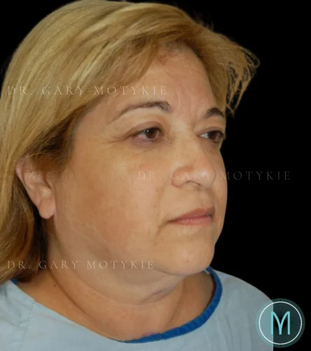 Neck Lift case #4870