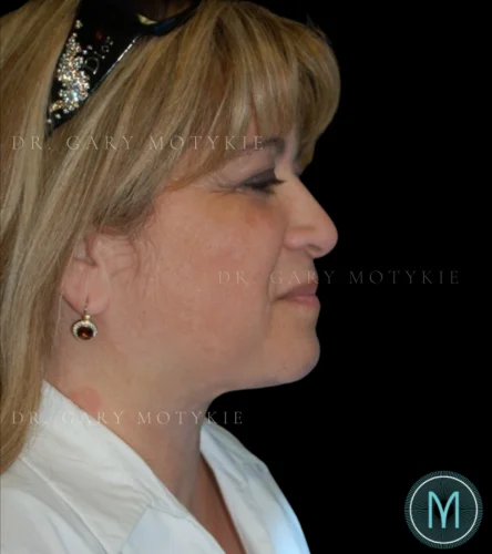 Neck Lift case #4870