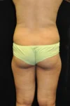 Brazilian Butt Lift case #3582