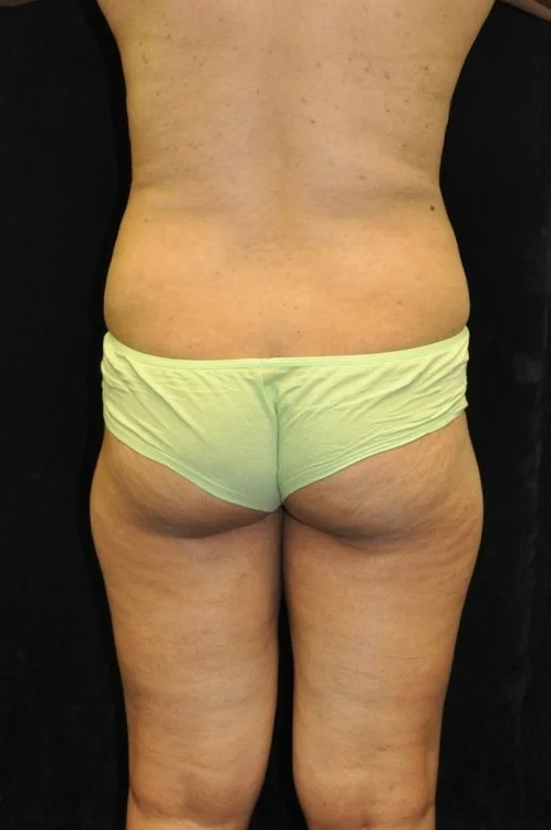 Brazilian Butt Lift case #3582