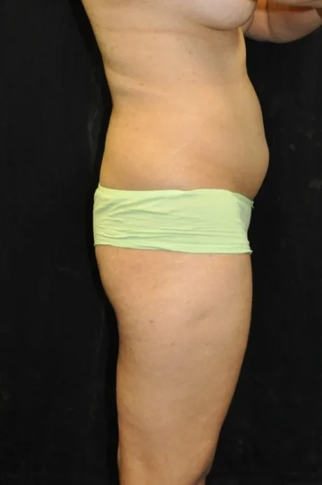 Brazilian Butt Lift case #3582