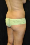 Brazilian Butt Lift case #3582
