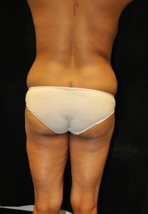 case-5-17-brazilian-butt-lift-view-1-1