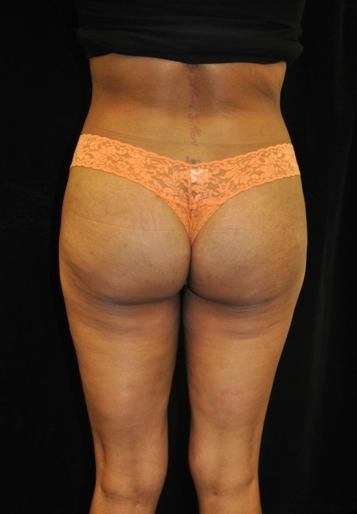 case-5-17-brazilian-butt-lift-view-1-2