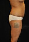 Brazilian Butt Lift case #3589