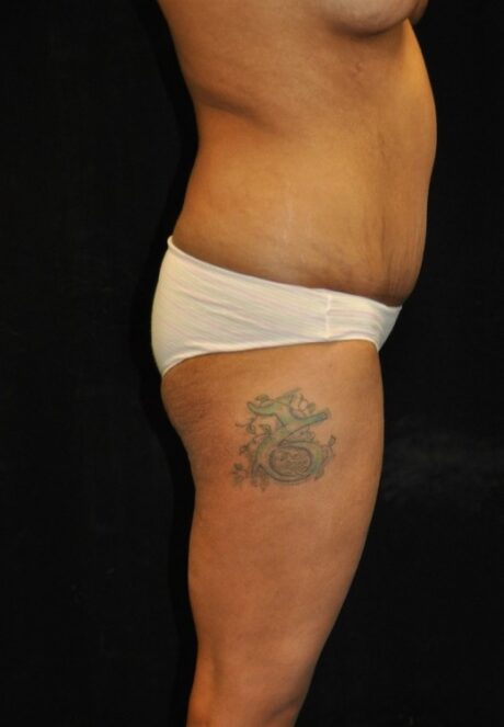 Brazilian Butt Lift case #3589