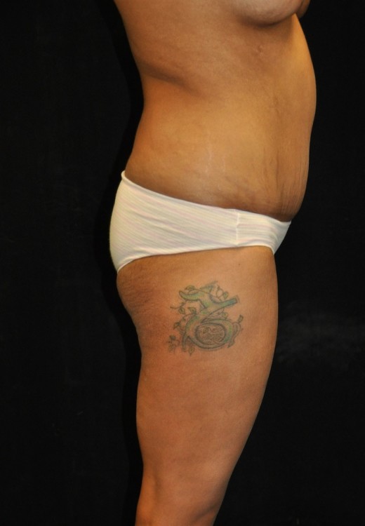 Brazilian Butt Lift case #3589