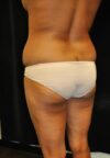 Brazilian Butt Lift case #3589