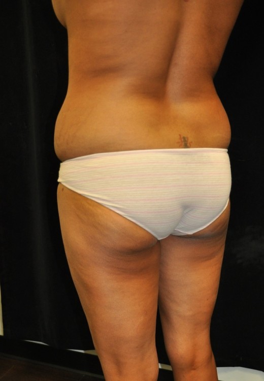 Brazilian Butt Lift case #3589