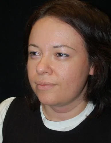 Blepharoplasty case #3532