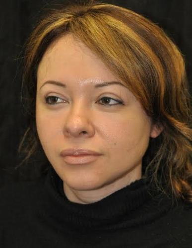 Blepharoplasty case #3532