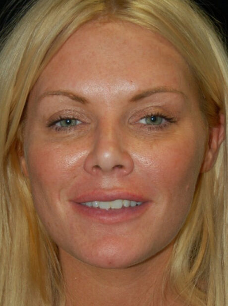 Blepharoplasty case #3498
