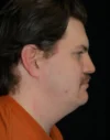 Neck Lift case #4875