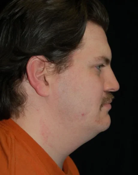 Neck Lift case #4875