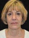 Lower Blepharoplasty case #3407