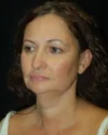 Blepharoplasty case #3504