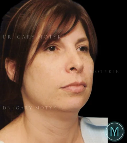 Neck Lift case #4880