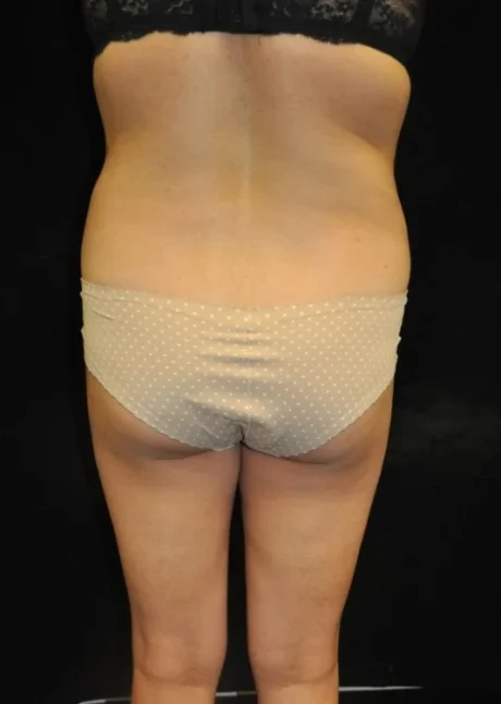 Brazilian Butt Lift case #3603