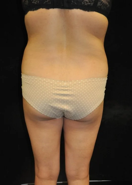 case-8-14-brazilian-butt-lift-view-1-1