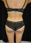 Brazilian Butt Lift case #3603