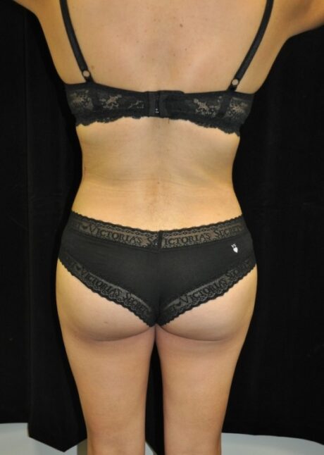 Brazilian Butt Lift case #3603
