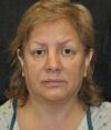 Lower Blepharoplasty case #3412