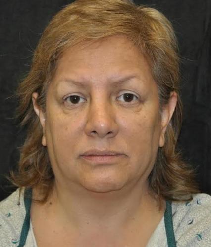 Lower Blepharoplasty case #3412