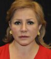 Lower Blepharoplasty case #3412